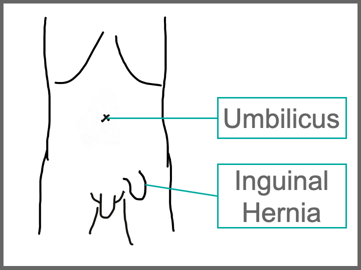 What is inguinal hernia?